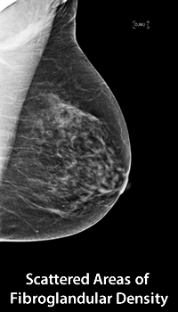 Scattered Areas of Fibroglandular Density