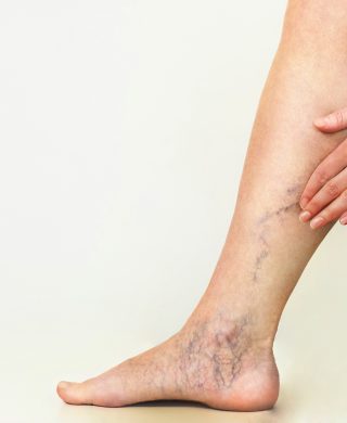 Varicose veins