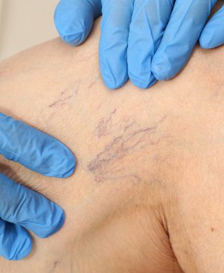 Image of spider veins