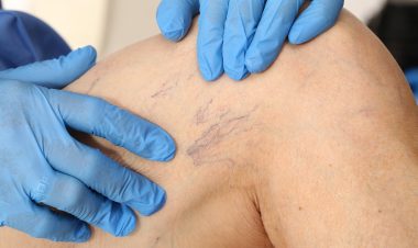 Image of spider veins