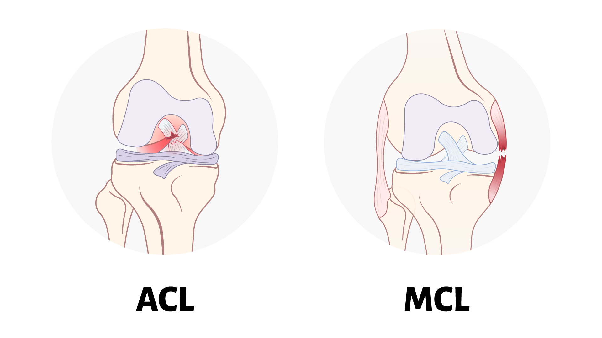 An educational rendering of the ACL and MCL with a diagram of the joints and ligaments