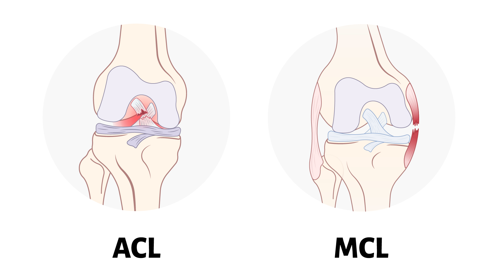 Love Your Ligaments: Tips for Preventing ACL and MCL Injuries