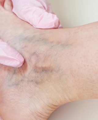 A foot with veins is held by a gloved hand, used to explain chronic vein disease and how it is treated