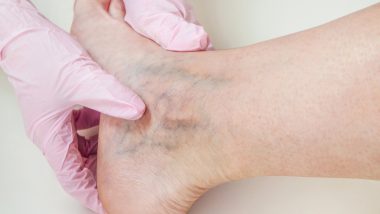 A foot with veins is held by a gloved hand, used to explain chronic vein disease and how it is treated